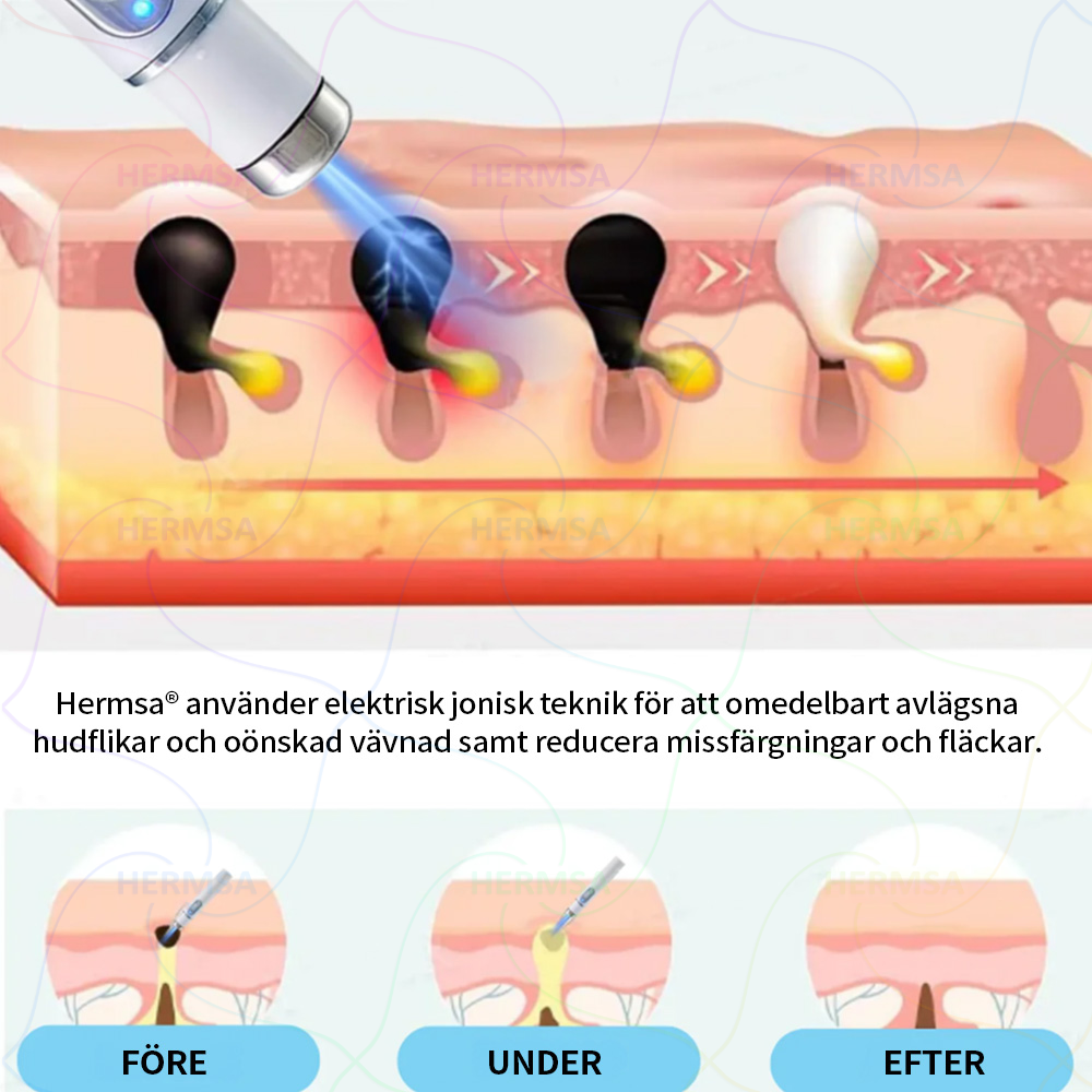 Hermsa® noninvasiivinen laserosoitin - luomen ja syylän poisto (🔥Viimeinen päivä 80% alennus)