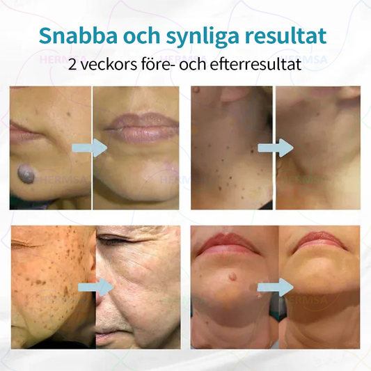 Hermsa® noninvasiivinen laserosoitin - luomen ja syylän poisto (🔥Viimeinen päivä 80% alennus)